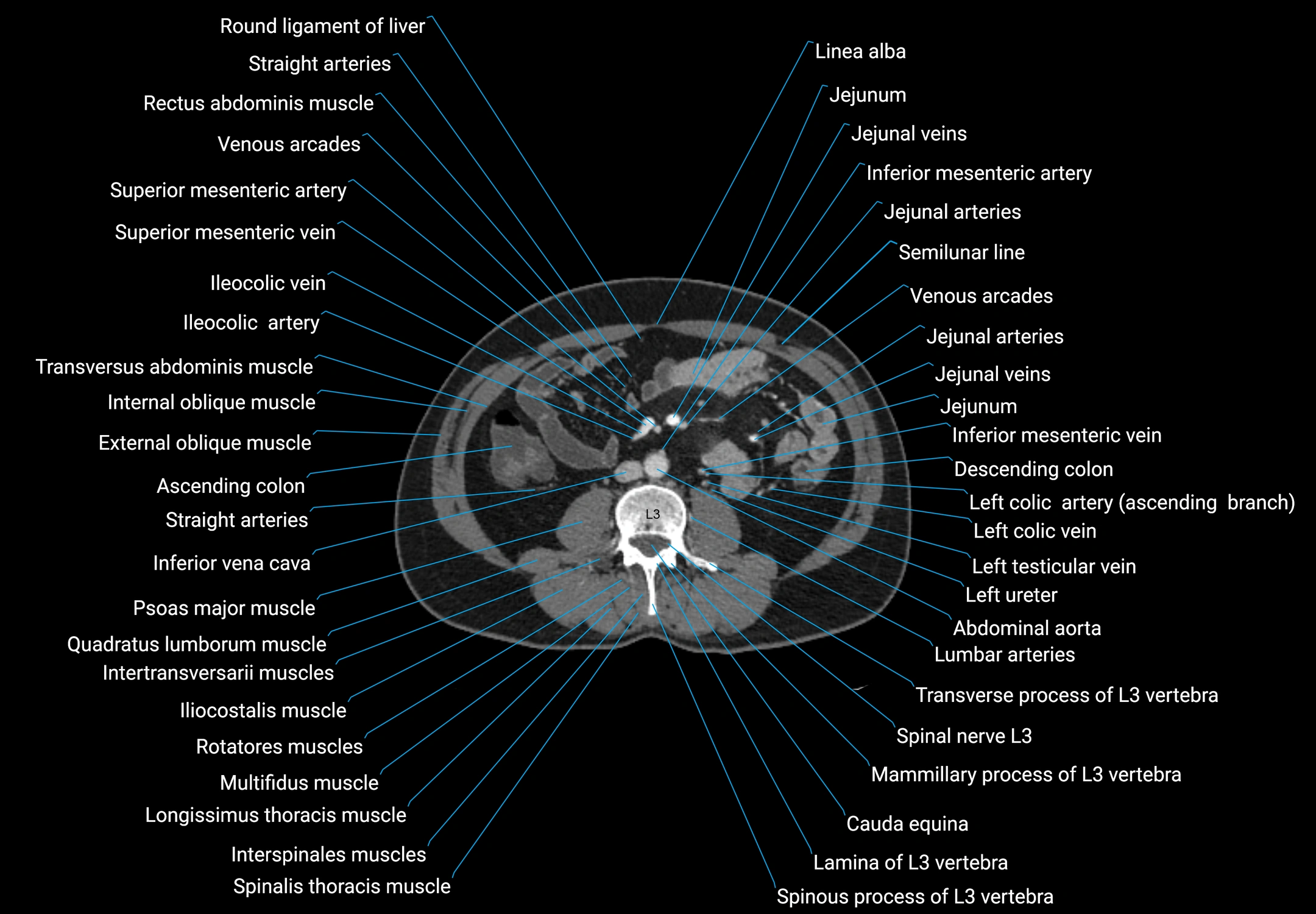 CT male pelvis axial cross sectional anatomy labelled radiology image -00092.webp